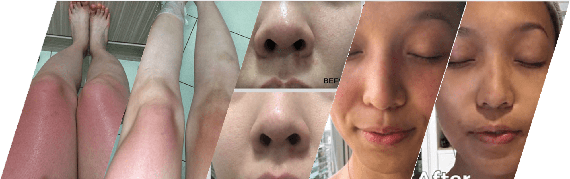 Before and after clinical comparison: legs, nose, and facial areas