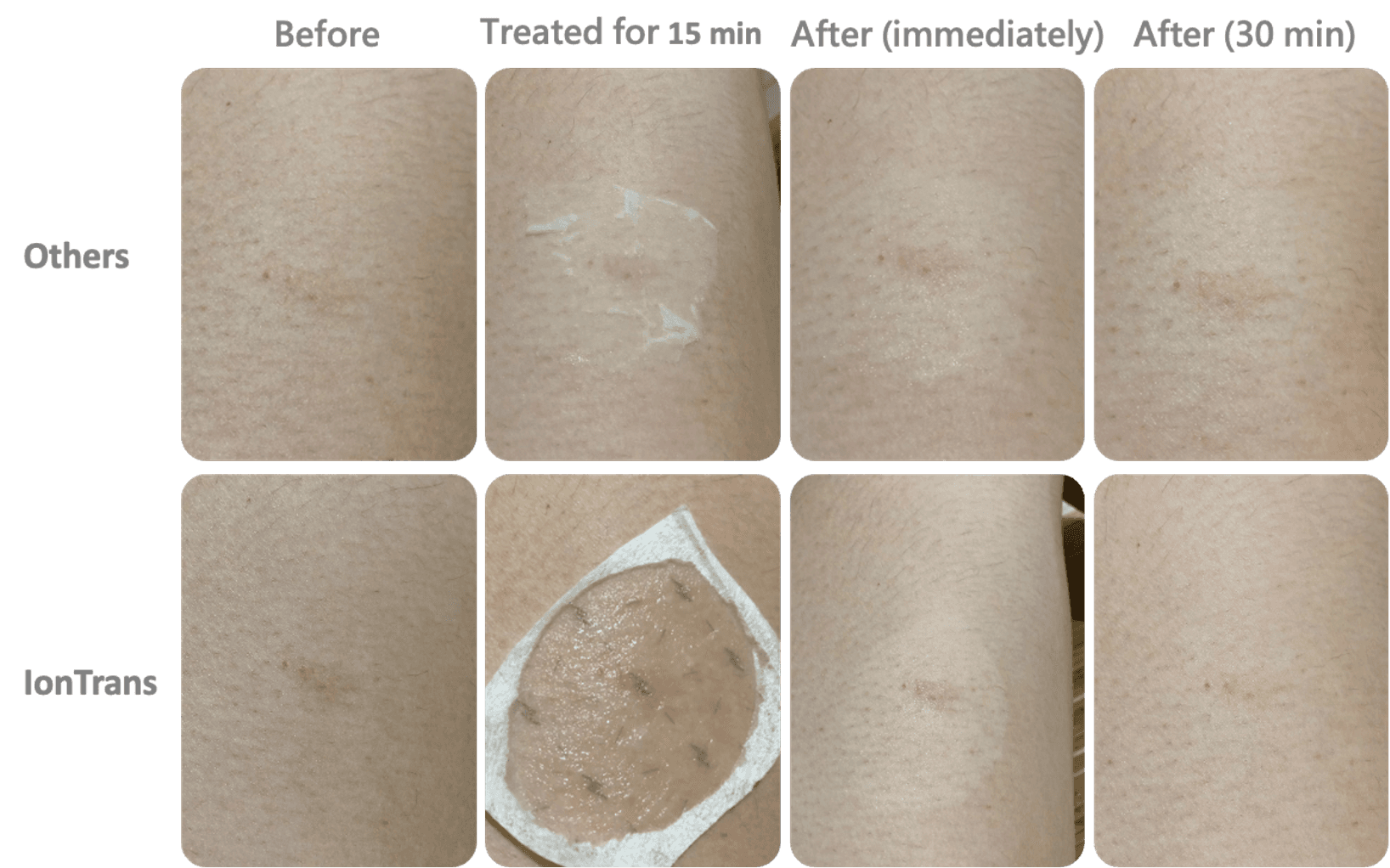 Arm skin comparison: Others versus IonFuse across Before, 15 min treatment, immediately after, and 30 minutes after
