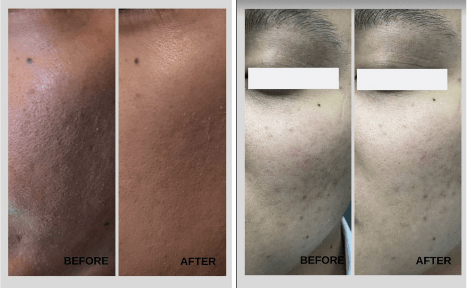 Before and after: cheek comparisons and under-eye area comparisons