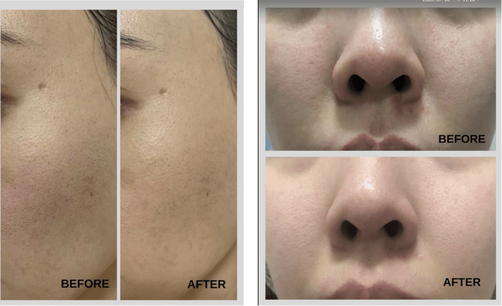 Before and after: cheek comparison and nose area comparison