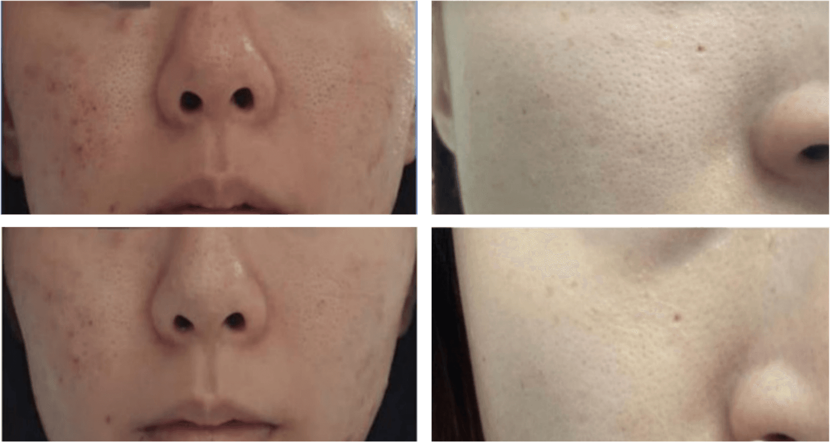 Before and after: four-panel comparison of nose, cheeks, and skin texture